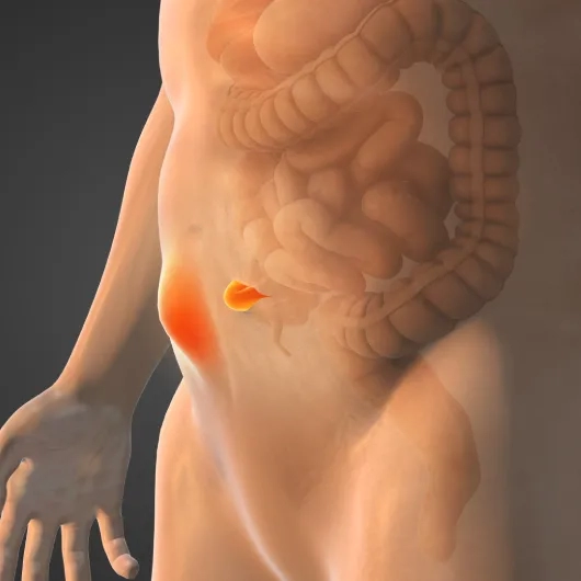 Incisional hernia surgery